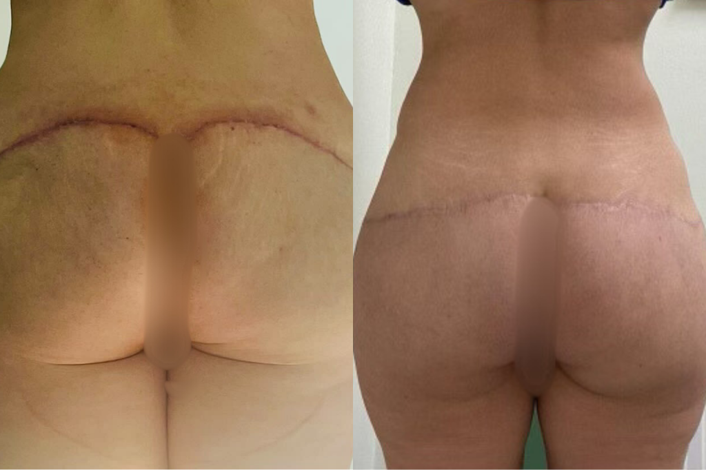 biopolymer removal surgeon in Miami