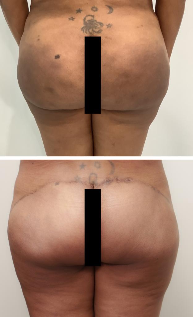 biopolymer removal before after south florida