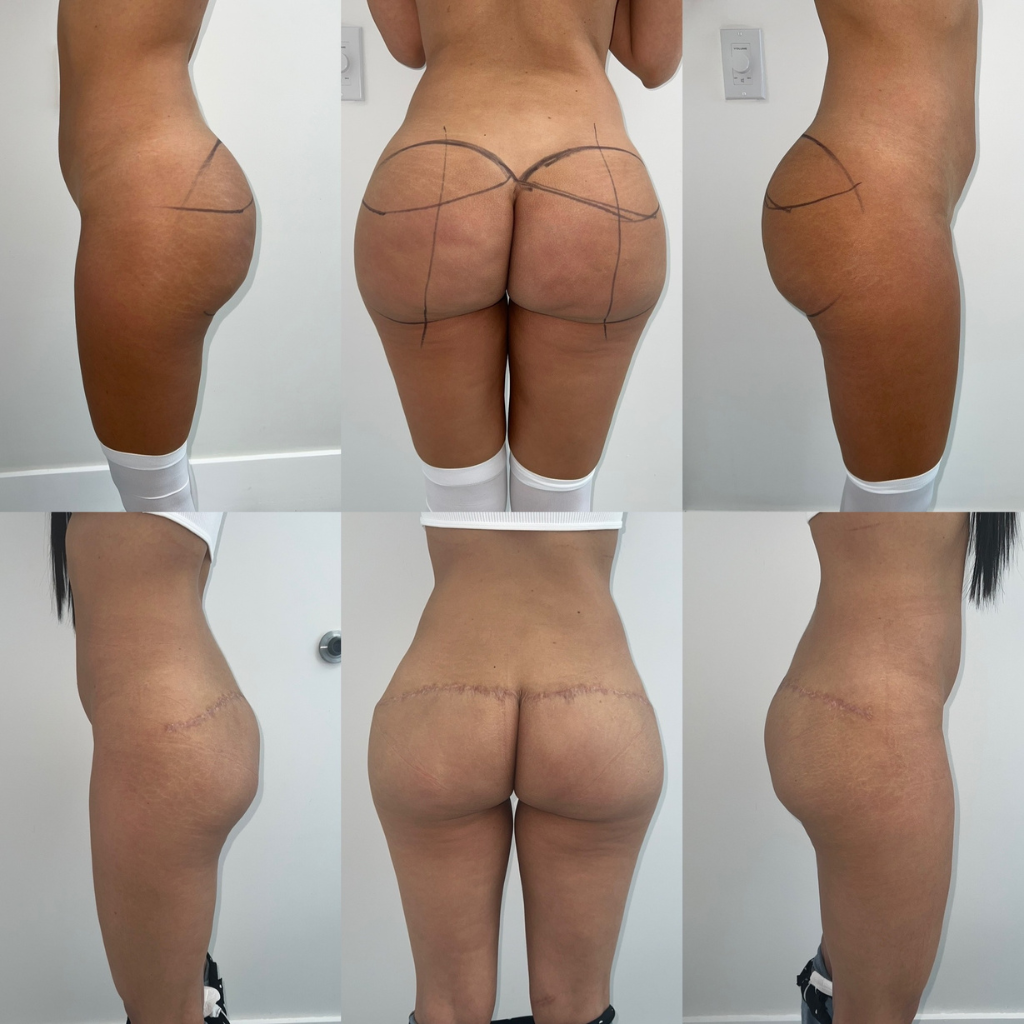 bipolymer removal before after south florida